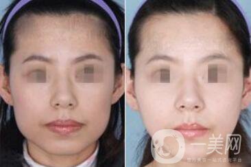 重慶做削骨瘦臉手術(shù)多少錢