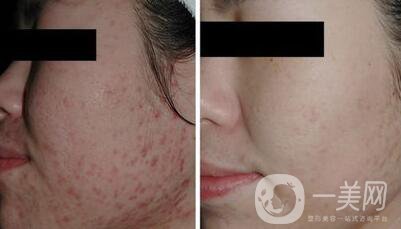 彩光祛痘原理是什么？*果如何