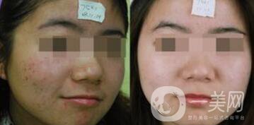 彩光祛痘原理是什么？*果如何