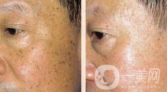 老年斑是如何產生的？怎么去老年斑