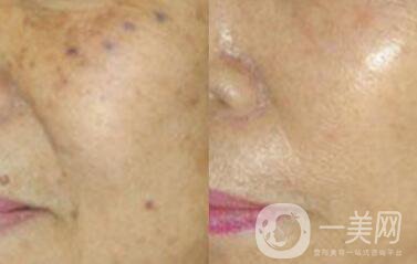 老年斑是如何產生的？怎么去老年斑