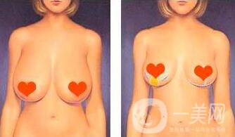 北京乳房下垂矯正手術多少錢