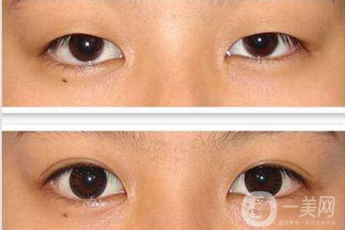 北京,雙眼皮,整形,價格