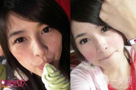 藍(lán)寶石激光祛斑好嗎