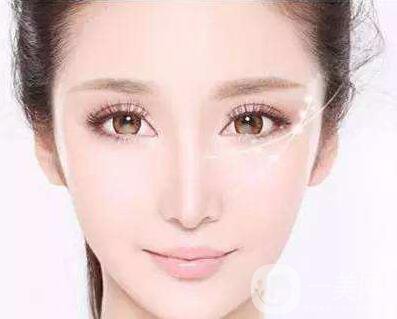 割雙眼皮有后遺癥嗎 后遺癥有哪些