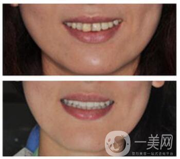 上海做貴金屬烤瓷牙多少錢(qián)