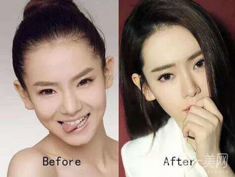 焊接雙眼皮是什么？多久能好？