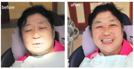 鄭州種植牙價格多少錢