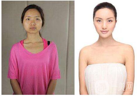 彩光嫩膚有用嗎 術(shù)后護(hù)理簡析