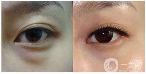 內(nèi)切去眼袋有后遺癥嗎 有哪些