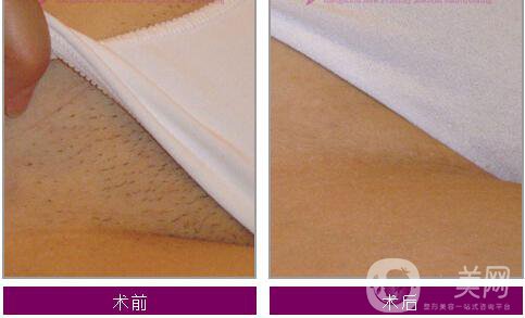廈門女性比基尼部位脫毛價(jià)格一般是多少