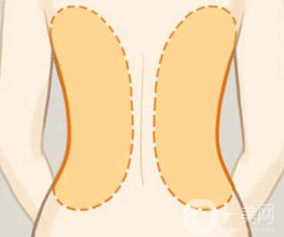 后背抽脂*果*嗎？