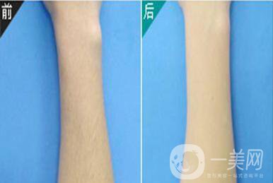 北京做激光脫毛的醫(yī)院介紹