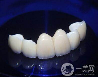 金鈀合金烤瓷牙價格多少錢？