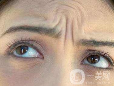 抬頭紋能消除嗎？有哪些方法？