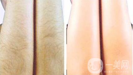 彩光脫毛會不會有副作用？