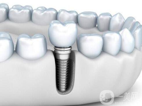 上海,種植牙,介紹