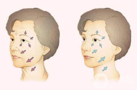 等離子除皺副作用有哪些？