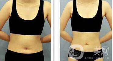 360度環(huán)形吸脂多久恢復 消腫恢復過程介紹