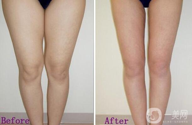 上海,抽脂瘦小腿,價(jià)格