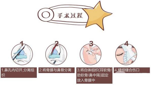 成都肋軟骨隆鼻價(jià)格需要多少錢