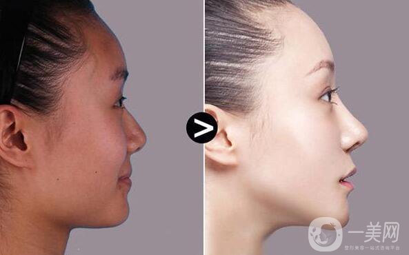 成都肋軟骨隆鼻價(jià)格需要多少錢