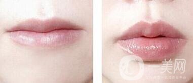 非手術豐唇方法具體有哪些