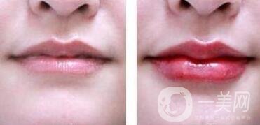 非手術豐唇方法具體有哪些
