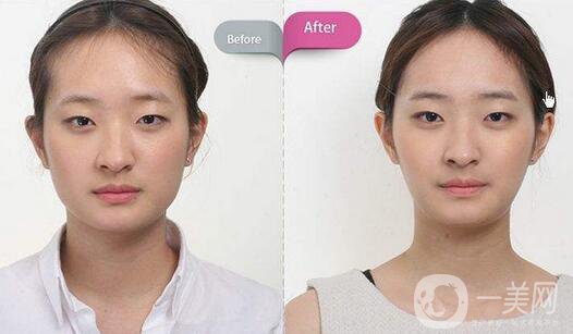 磨骨多少錢(qián)？磨骨價(jià)格盤(pán)點(diǎn)！