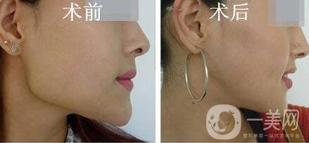 磨骨多少錢(qián)？磨骨價(jià)格盤(pán)點(diǎn)！