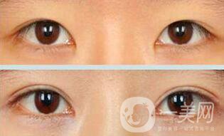 疤痕皮膚能割雙眼皮么 會有影響嗎