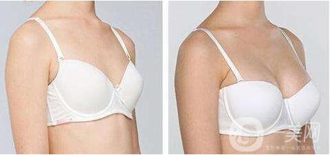北京,假體豐胸,多少錢