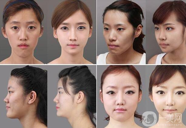 北京顴骨手術(shù)要多少錢？