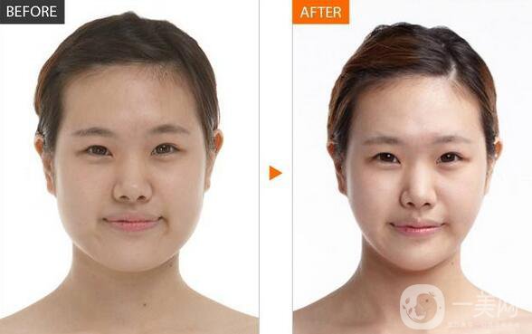 北京顴骨手術(shù)要多少錢？