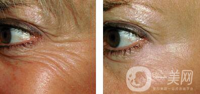 去除魚尾紋的方法具體有哪些