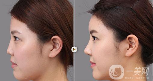 自體耳軟骨墊鼻梁隆鼻手術(shù)*果好嗎