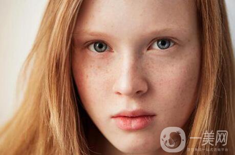 黃褐斑能用激光去除嗎？