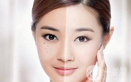 黃褐斑能用激光去除嗎？