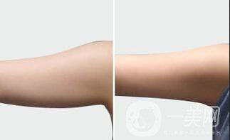 廣東手臂吸脂需要多少錢