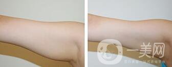 廣東手臂吸脂需要多少錢?