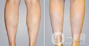南京光纖溶脂瘦小腿價格是多少