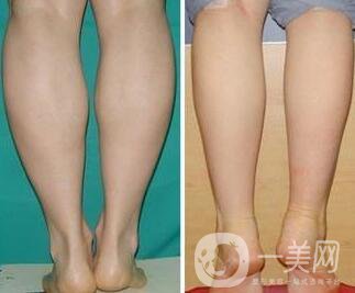 南京光纖溶脂瘦小腿價格是多少