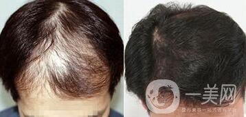 鄭州植發(fā)醫(yī)院信息介紹？植發(fā)去介紹