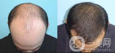 鄭州植發(fā)醫(yī)院信息介紹？植發(fā)去介紹