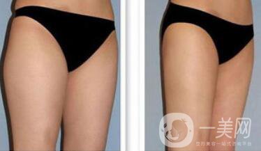 吸脂*嗎？吸脂手術(shù)有風(fēng)險嗎