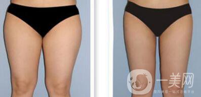 吸脂*嗎？吸脂手術(shù)有風(fēng)險嗎