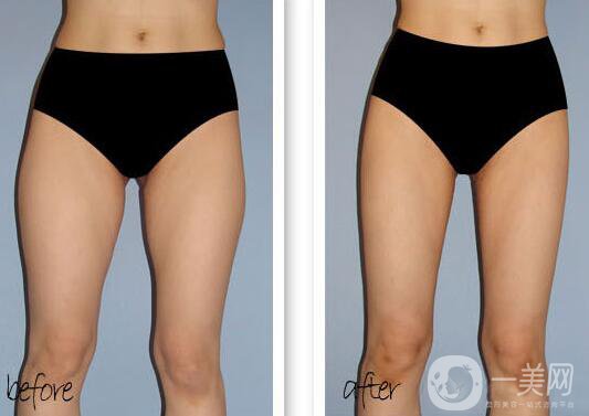 等離子激光溶脂*果怎么樣