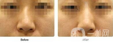 歪鼻矯正需要恢復(fù)多久？術(shù)后需要注意什么