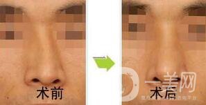 歪鼻矯正需要恢復(fù)多久？術(shù)后需要注意什么