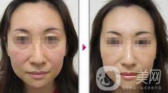 小切口面部提升*果怎么樣？會不會留疤